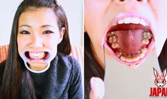 Ortho Obsession: My Journey with Braces