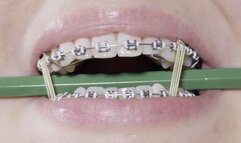 braces close-up with storytelling at the dentist