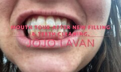 Mouth Tour after first DENTAL CLEANING IN YEARS & NEW FILING