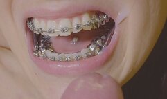 EPIC Braces HERBST and expander handjob