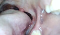 Katie's Endoscopic Mouth Tour