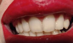 Sharp vampire teeth treatment