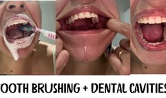 Tooth brushing + dental cavities