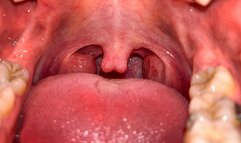 The Uvula During Yawning CUSTOM