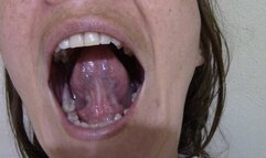 Mouth With Temporary Crown