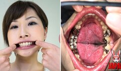 Teeth Inspection Chronicles: a full crown and inlays Yua Hidaka's Enigmatic Oral Realm