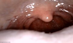 yawning uvula endoscopy (720 mp4)