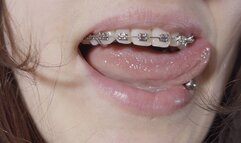 braces close-up and rubber-bands ASMR