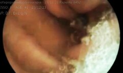 Medical exam in hospital video of medical endoscopy in full screen 720wmv